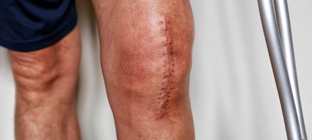 close up of swollen knee with stitches